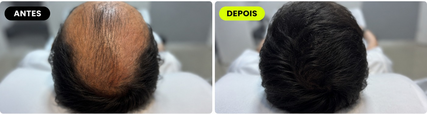 Antes e depois - Protocolo For Man